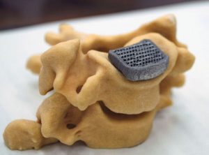 3-D Printed Artifical Bone