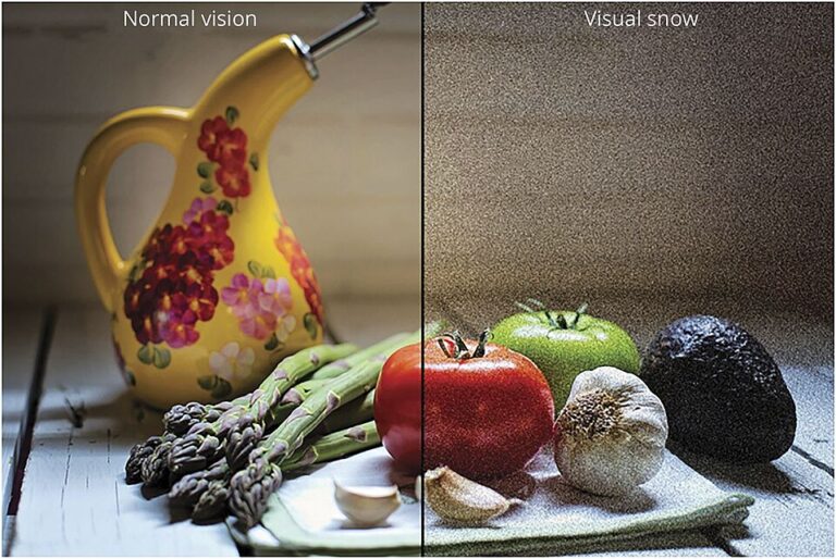 Geeking Science: Visual Snow vs. Visual Snow Syndrome – Erin Penn's ...